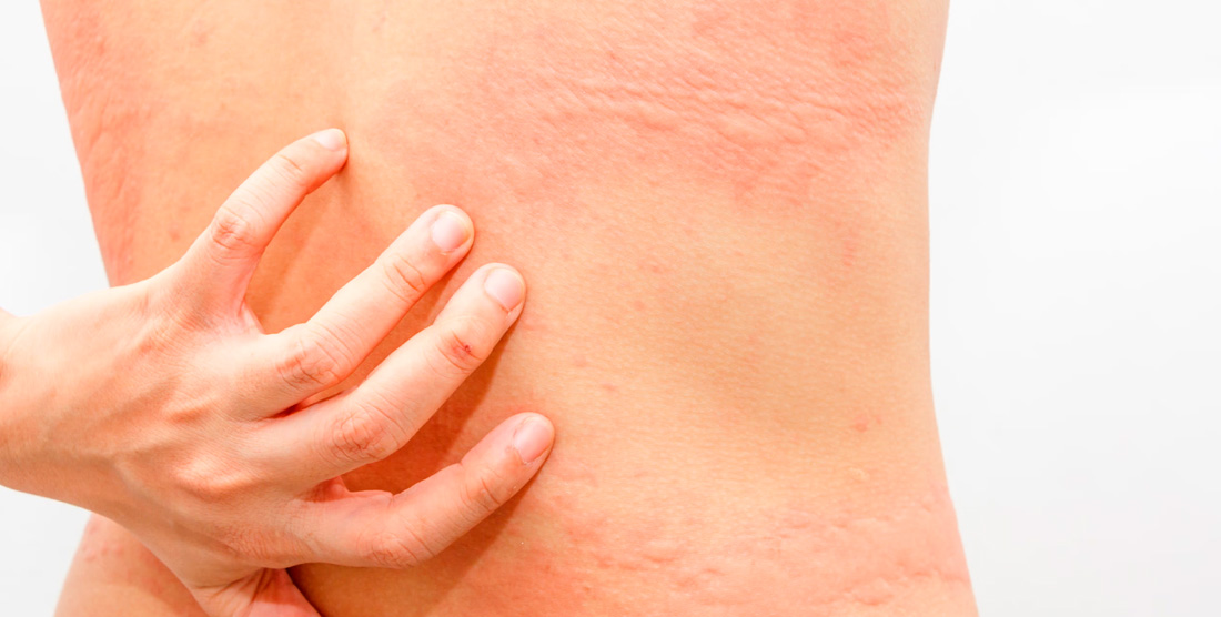Síntomas más comunes de la alergia al sol